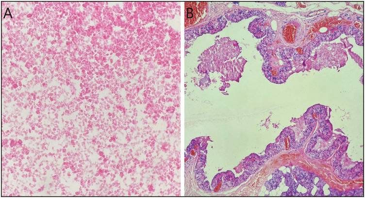 The Second Edition of the Milan System for Reporting Salivary Gland Cytopathology: System Application, Outcome, and Cytohistological Correlation.