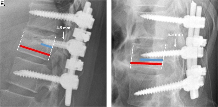 The effect of the size of pedicle screw on the long-term radiological and clinical results of short-segment posterior instrumentation in the management of thoracolumbar vertebral fractures.