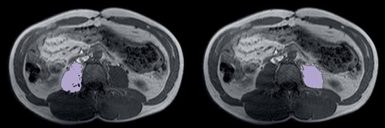 Diagnostic value of apparent diffusion coefficient of psoas muscles for evaluating complications in patients with Crohn's disease.