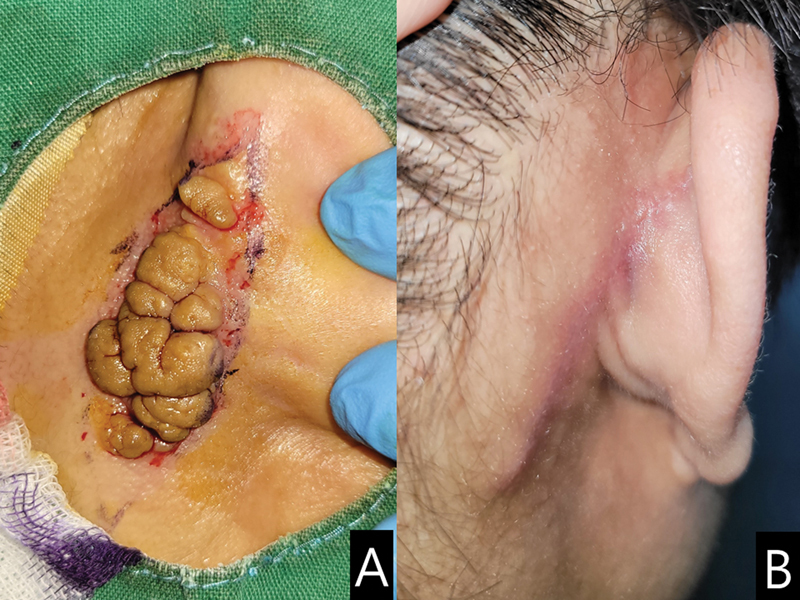 The Nevus Lipomatosus Superficialis of Face: A Case Report and Literature Review.