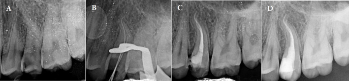Enhancing Coronal Adaptation of Root Canal Fillings with a Modified Single-Cone Obturation Technique: Two Case Reports.