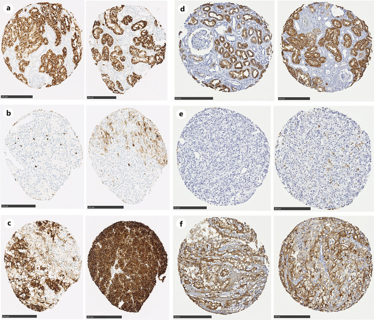 CD15 Is a Risk Predictor and a Novel Target in Clear Cell Renal Cell Carcinoma.