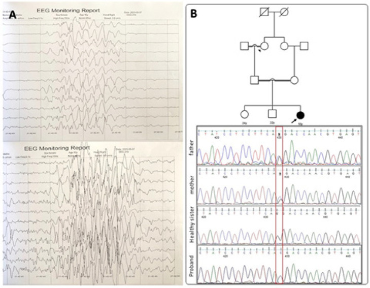 Identification of a Novel <i>ASAH1</i> Gene Mutation in Spinal Muscular Atrophy with Progressive Myoclonic Epilepsy.