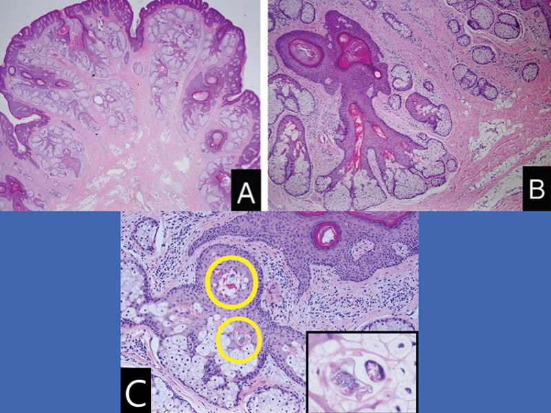 The Nevus Lipomatosus Superficialis of Face: A Case Report and Literature Review.