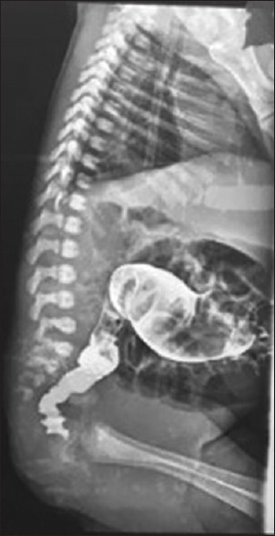 Our Experience of the De la Torre-Mondragon Technique in the Surgical Management of Hirschsprung's Disease: A Report on 52 Cases.