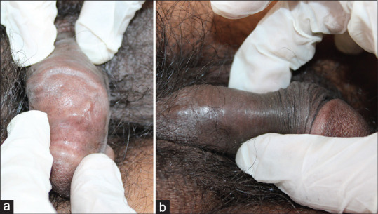 Penile Mondor's disease co-occurring with sclerosing lymphangitis: A double whammy.