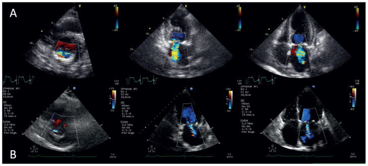 The impact of transcatheter aortic valve implantation (TAVI) on mitral regurgitation - a single center study.