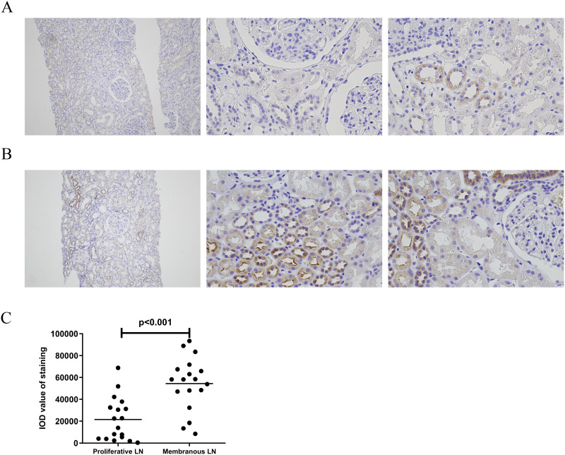 Association of Mitochondrial Pyruvate Carrier with the Clinical and Histological Features in Lupus Nephritis.
