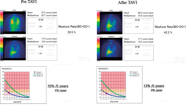 Cardiac Sympathetic Nerve Function in Patients with Severe Aortic Stenosis Prior and After Transcatheter Aortic Valve Implantation: Evaluation by 5-Year Risk Model.