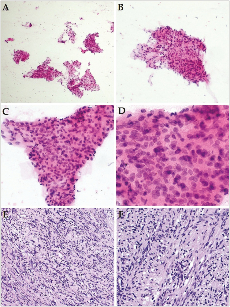 The Second Edition of the Milan System for Reporting Salivary Gland Cytopathology: System Application, Outcome, and Cytohistological Correlation.