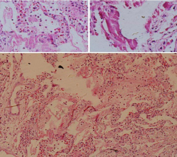 Histopathological Examination of Lung Necropsy of 11 Patients Who Died Due to COVID-19: A Case Series.