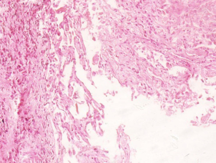 Histopathological Examination of Lung Necropsy of 11 Patients Who Died Due to COVID-19: A Case Series.