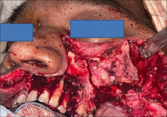 Osteomyelitis of the Jaw Due to Mucormycosis after Coronavirus Disease 2019 Infection - A Prospective Study.