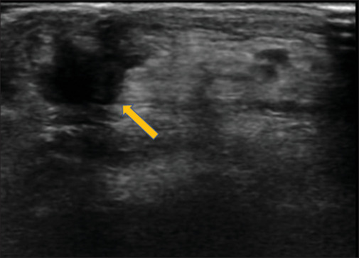 Current treatment concepts for Achilles tendon rupture.