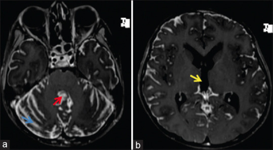 Primary diffuse leptomeningeal primitive neuroectodermal tumor presenting as chronic meningitis.