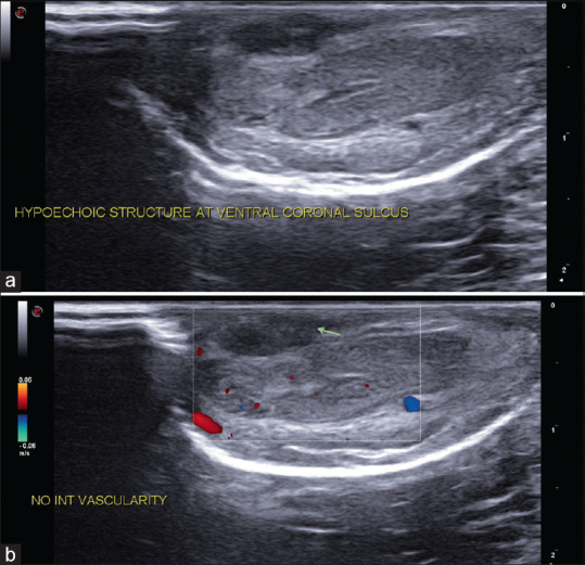 Penile Mondor's disease co-occurring with sclerosing lymphangitis: A double whammy.