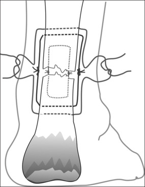 Current treatment concepts for Achilles tendon rupture.
