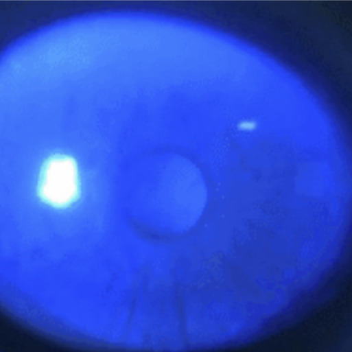 Dry eye disease: an introduction.