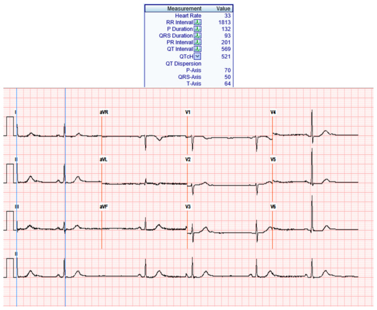 Calcium Channel Blocker Overdose.