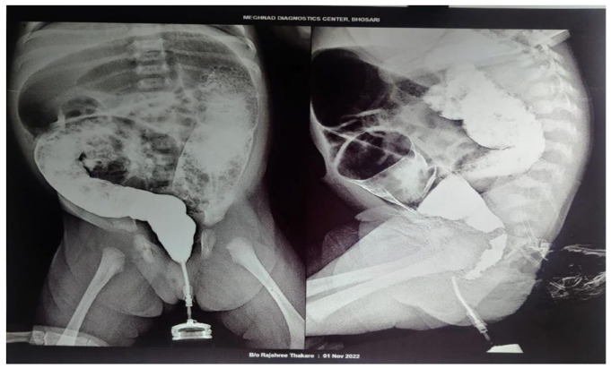 Early Detection and Intervention for Hirschsprung's Disease: A Key to Successful Outcomes.