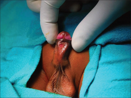 Congenital Urethrocutaneous Fistula.