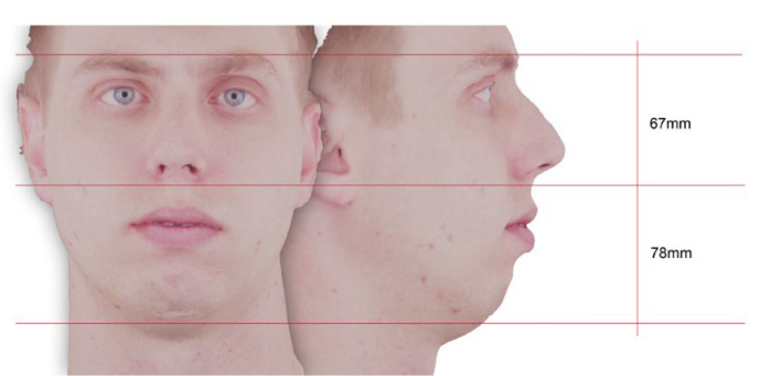 An Open Source Framework for Free Precise Digital Facial Analysis.