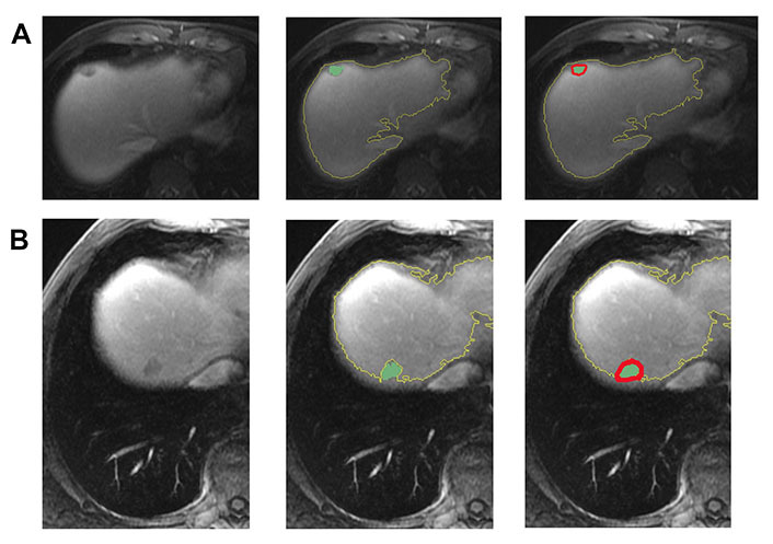 Quantitative peritumoral magnetic resonance imaging fingerprinting improves machine learning-based prediction of overall survival in colorectal cancer.