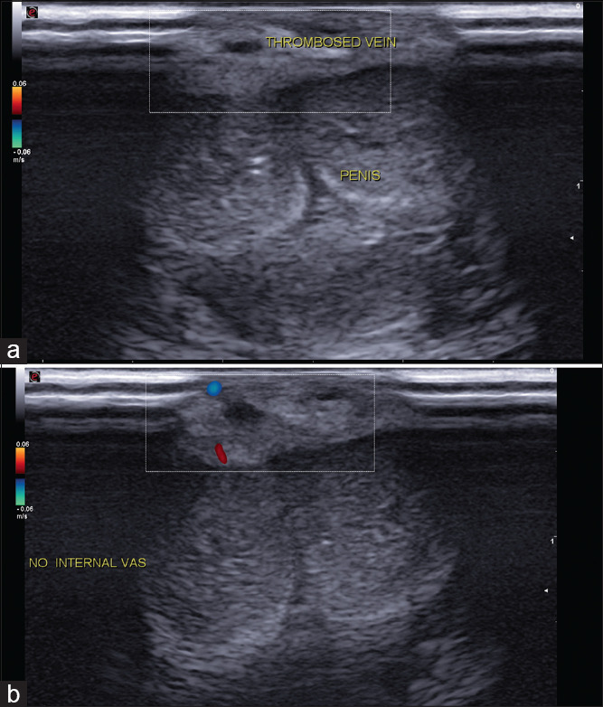 Penile Mondor's disease co-occurring with sclerosing lymphangitis: A double whammy.