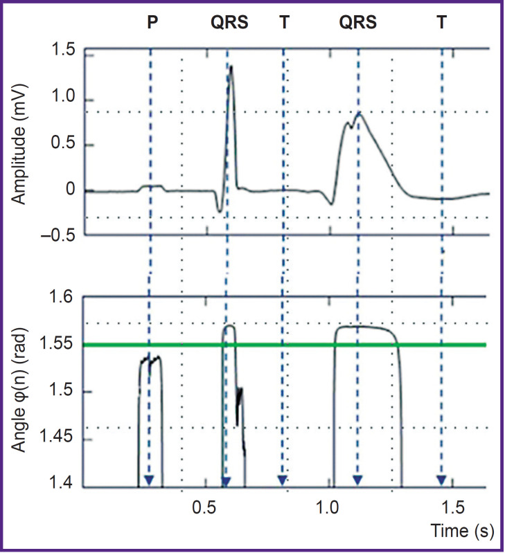 Digital Electrocardiographic Complex for Risk Stratification of Paroxysmal Atrial Fibrillation.