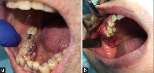 Impact of Early Diagnosis of Maxillofacial Metastases on Treatment and Patient Outcomes - A Retrospective Study.