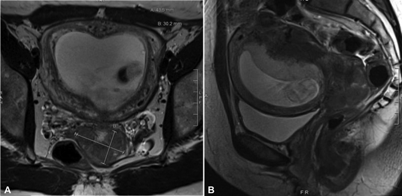 Small Cell Cervical Carcinoma in Pregnancy: Therapeutic Options for an Aggressive Cancer Diagnosis.