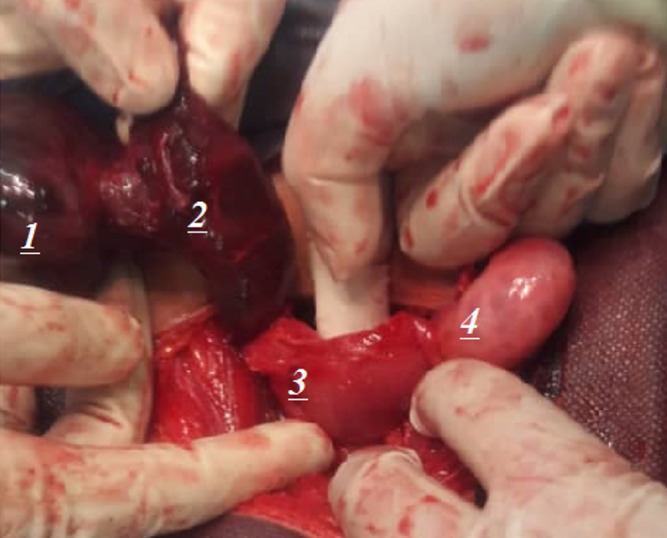 Pediatric Ovarian Torsion in an 8-year Old Girl; A Case Report Study.