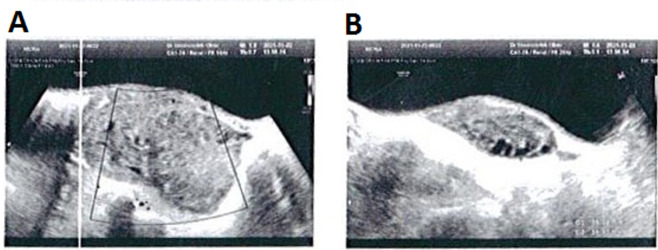Pediatric Ovarian Torsion in an 8-year Old Girl; A Case Report Study.