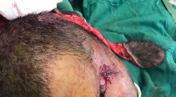 Temporoparietal Flap for Facial Reconstruction: Donor Site Morbidity.