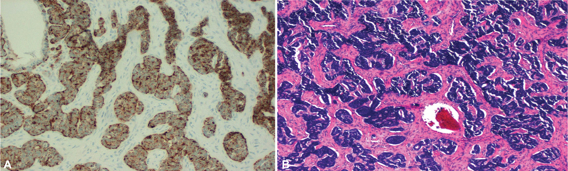 Small Cell Cervical Carcinoma in Pregnancy: Therapeutic Options for an Aggressive Cancer Diagnosis.