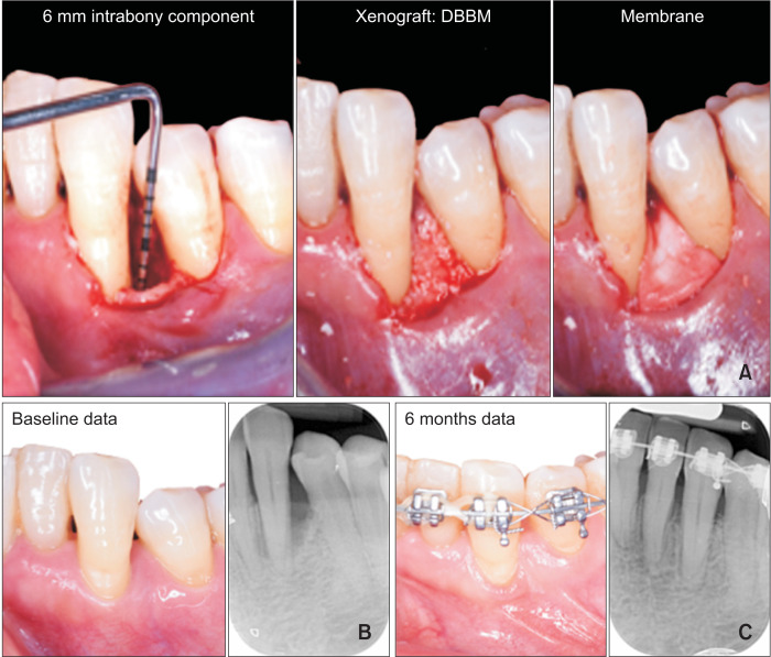 Orthodontic tooth movement after periodontal regeneration of intrabony defects.