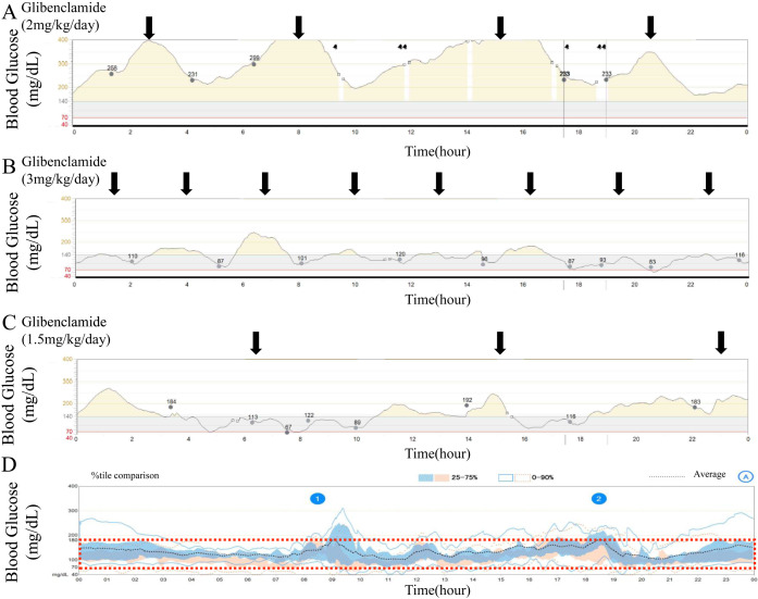 Use of a long-term continuous glucose monitor for predicting sulfonylurea dose in patients with neonatal diabetes mellitus: a case series.