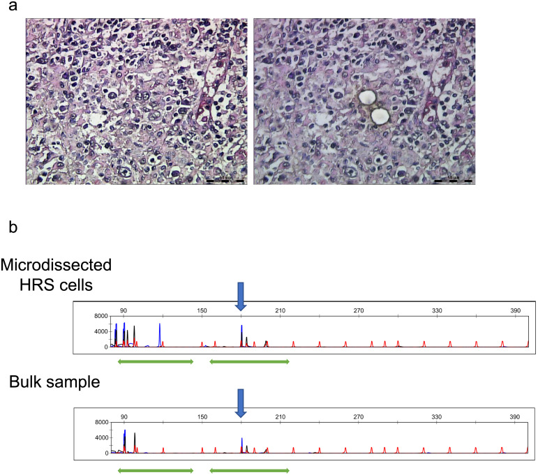 T-cell receptor gamma gene rearrangement analysis of classic Hodgkin lymphoma using a BIOMED-2 assay: a paraffin-embedded tissue analysis of one hundred cases.