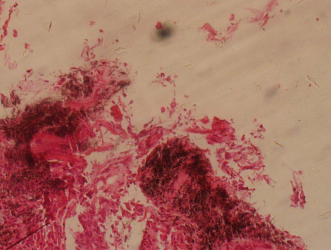 Histopathological Examination of Lung Necropsy of 11 Patients Who Died Due to COVID-19: A Case Series.