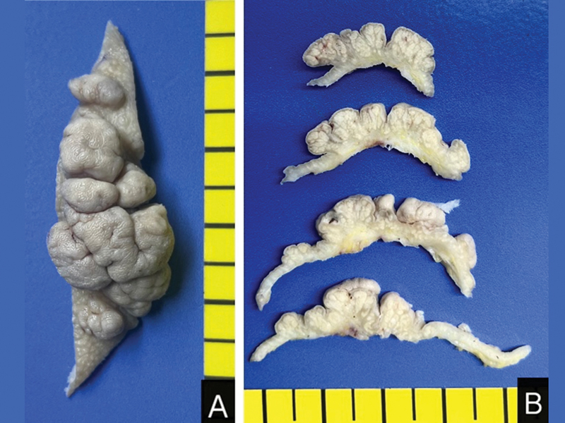 The Nevus Lipomatosus Superficialis of Face: A Case Report and Literature Review.