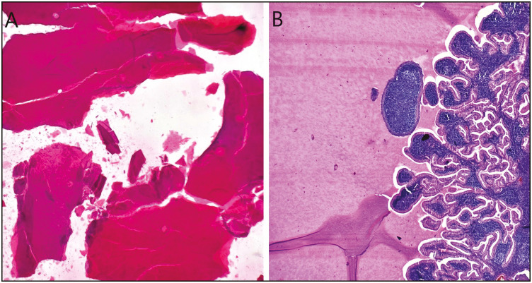 The Second Edition of the Milan System for Reporting Salivary Gland Cytopathology: System Application, Outcome, and Cytohistological Correlation.