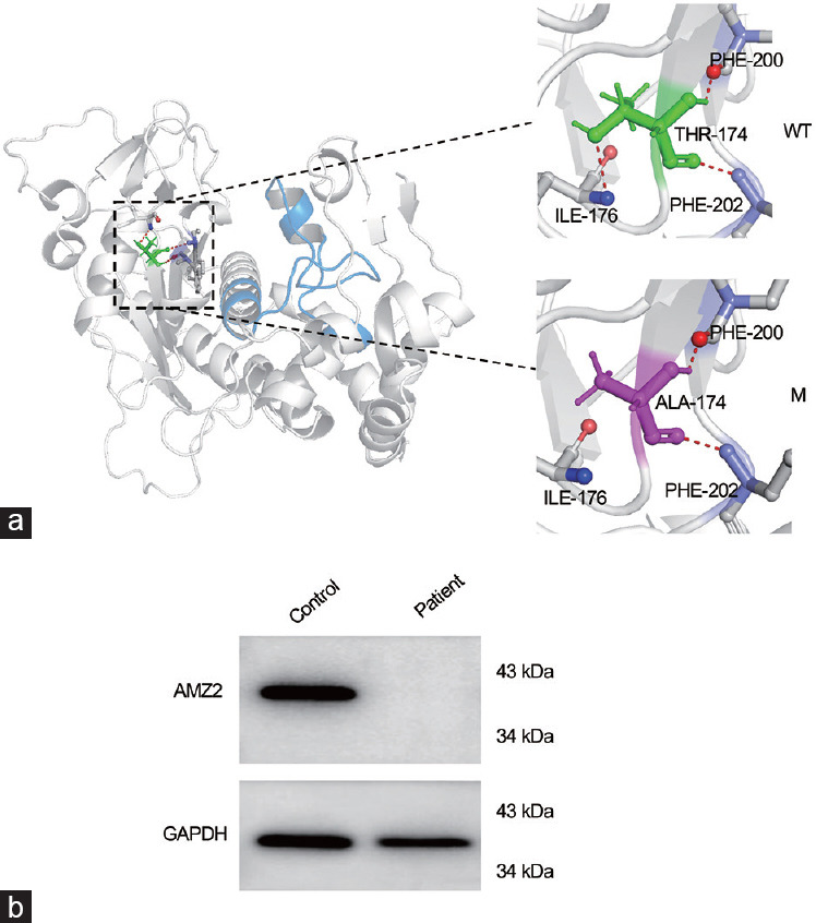 The identification of AMZ2 as a candidate causative gene in a severe teratozoospermia patient characterized by vacuolated spermatozoa.