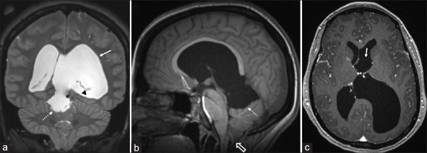 Intraventricular membrane with ventricular diverticulum.