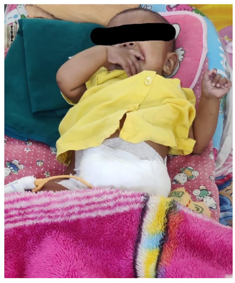 Early Detection and Intervention for Hirschsprung's Disease: A Key to Successful Outcomes.