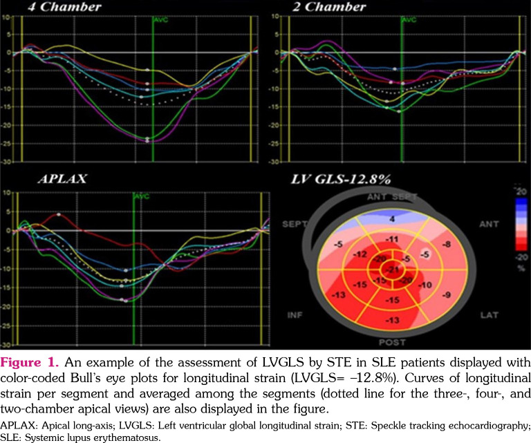 Left ventricular systolic function assessed by standard and advanced echocardiographic techniques in patients with systemic lupus erythematosus: A systemic review and meta-analysis.