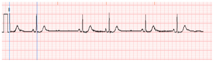 Calcium Channel Blocker Overdose.