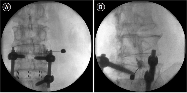 Multimodal management strategies for chronic pain after spinal surgery: a comprehensive review.