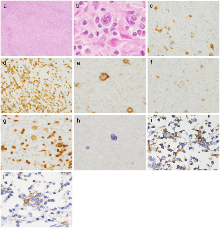 T-cell receptor gamma gene rearrangement analysis of classic Hodgkin lymphoma using a BIOMED-2 assay: a paraffin-embedded tissue analysis of one hundred cases.