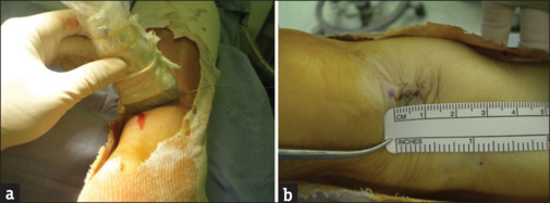 Current treatment concepts for Achilles tendon rupture.