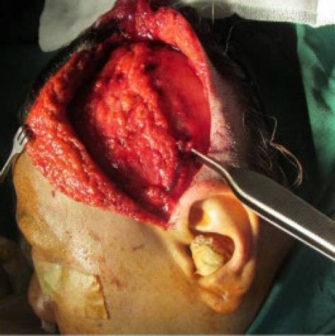 Temporoparietal Flap for Facial Reconstruction: Donor Site Morbidity.